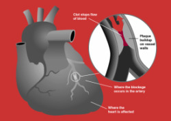 Atherosclerotic plaque build up